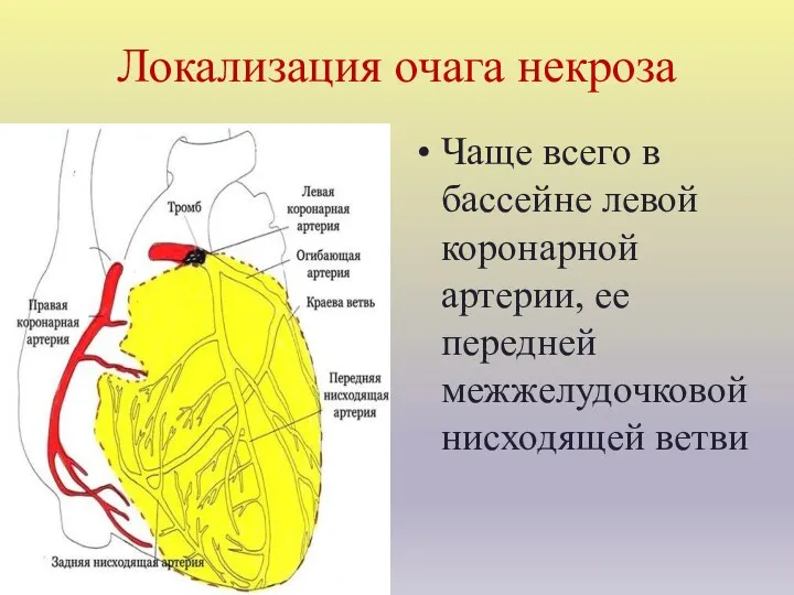 Локализация очага некроза Чаще всего в бассейне левой коронарной артерии, ее передней межжелудочковой нисходящей ветви
