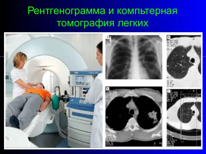 Рентгенограмма и компьтерная томография легких
