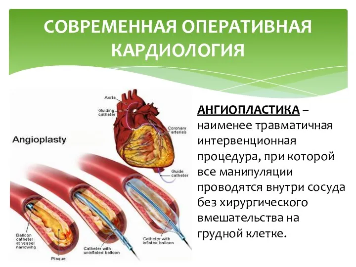 СОВРЕМЕННАЯ ОПЕРАТИВНАЯ КАРДИОЛОГИЯ АНГИОПЛАСТИКА – наименее травматичная интервенционная процедура, при