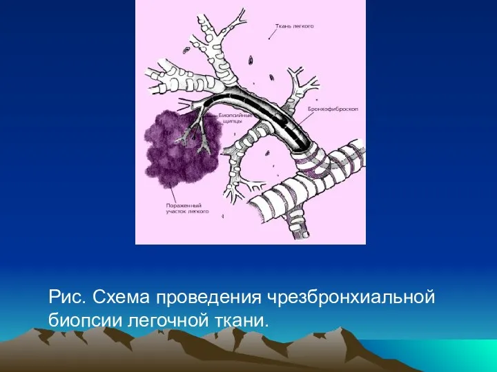 Рис. Схема проведения чрезбронхиальной биопсии легочной ткани.