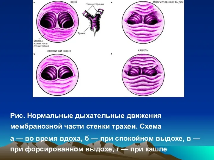 Рис. Нормальные дыхательные движения мембранозной части стенки трахеи. Схема а