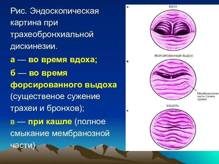 Рис. Эндоскопическая картина при трахеобронхиальной дискинезии. а — во время