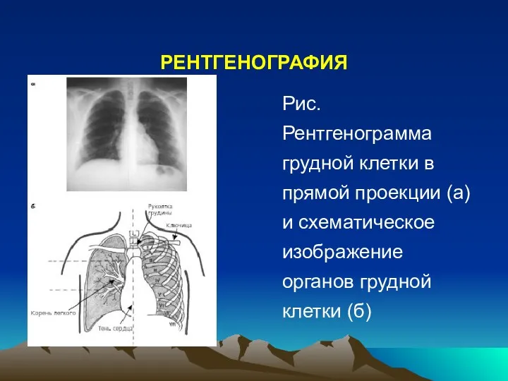 РЕНТГЕНОГРАФИЯ Рис. Рентгенограмма грудной клетки в прямой проекции (а) и схематическое изображение органов грудной клетки (б)