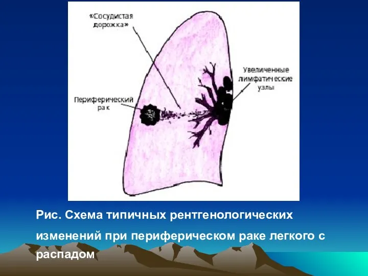 Рис. Схема типичных рентгенологических изменений при периферическом раке легкого с распадом