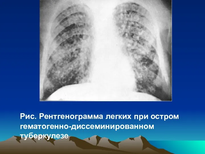 Рис. Рентгенограмма легких при остром гематогенно-диссеминированном туберкулезе