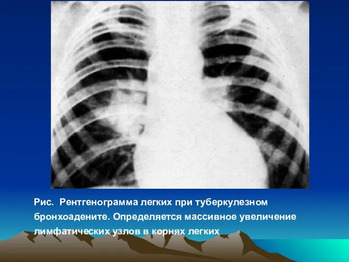 Рис. Рентгенограмма легких при туберкулезном бронхоадените. Определяется массивное увеличение лимфатических узлов в корнях легких