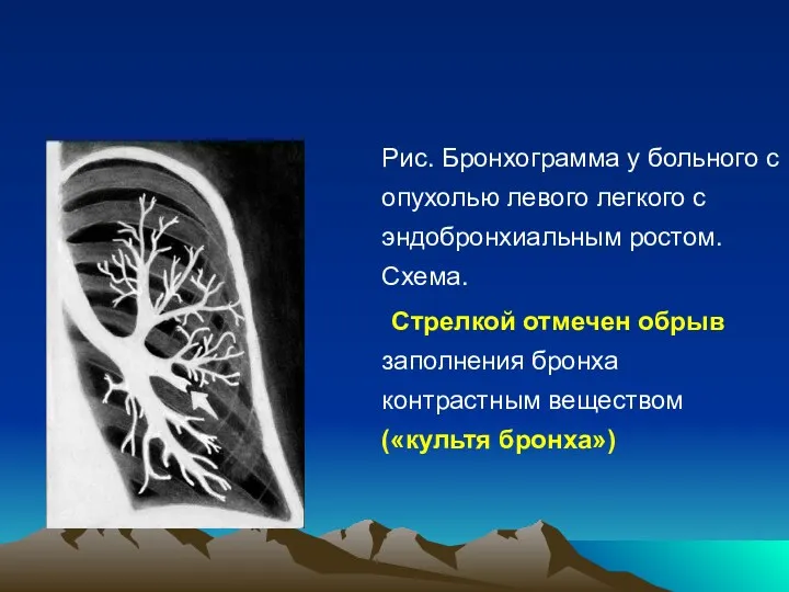 Рис. Бронхограмма у больного с опухолью левого легкого с эндобронхиальным