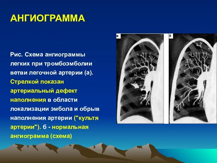 АНГИОГРАММА Рис. Схема ангиограммы легких при тромбоэмболии ветви легочной артерии