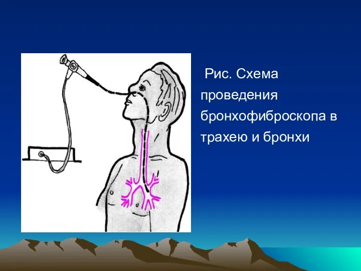 Рис. Cхема проведения бронхофиброскопа в трахею и бронхи