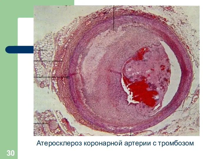 Атеросклероз коронарной артерии с тромбозом