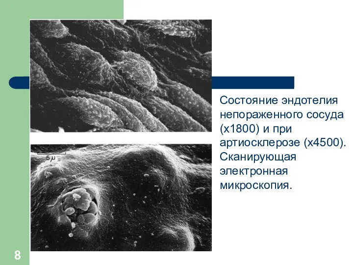 Состояние эндотелия непораженного сосуда (х1800) и при артиосклерозе (х4500). Сканирующая электронная микроскопия.