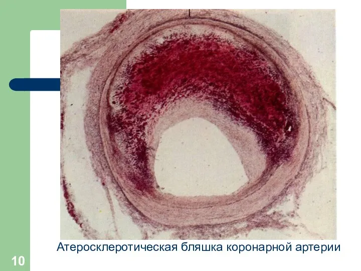 Атеросклеротическая бляшка коронарной артерии