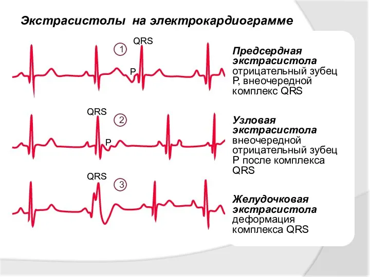 Экстрасистолы на электрокардиограмме 1 2 3 Предсердная экстрасистола отрицательный зубец