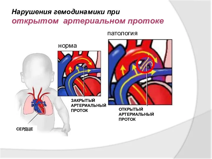 Нарушения гемодинамики при открытом артериальном протоке НОРМАЛЬНАЯ ЦИРКУЛЯЦИЯ ЗАКРЫТЫЙ АРТЕРИАЛЬНЫЙ