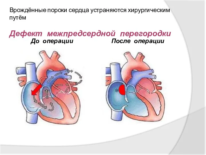 До операции После операции Врождённые пороки сердца устраняются хирургическим путём Дефект межпредсердной перегородки