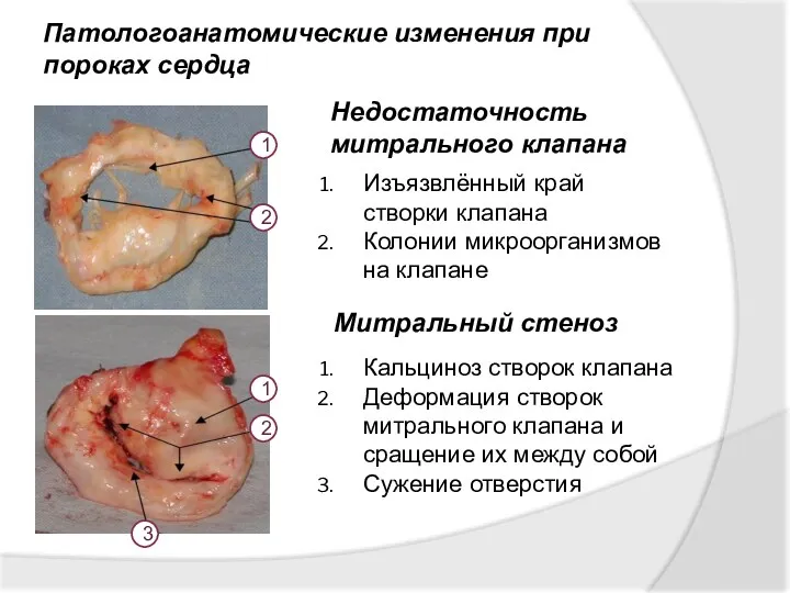 Патологоанатомические изменения при пороках сердца Изъязвлённый край створки клапана Колонии