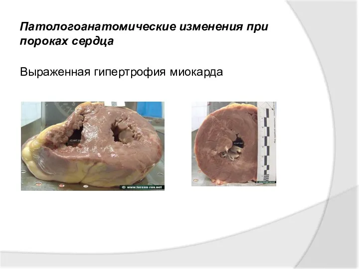 Патологоанатомические изменения при пороках сердца Выраженная гипертрофия миокарда