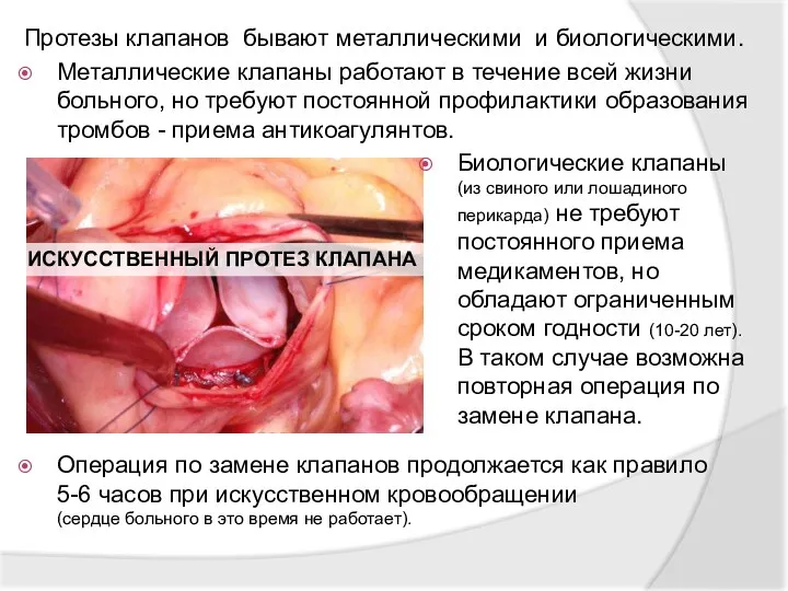 Протезы клапанов бывают металлическими и биологическими. Металлические клапаны работают в