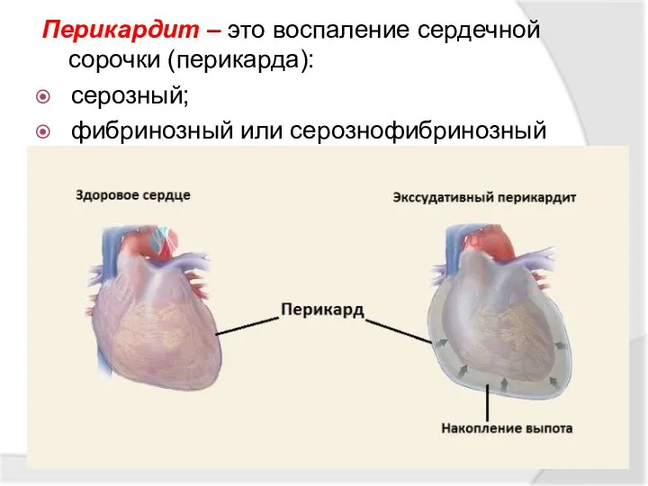 Перикардит – это воспаление сердечной сорочки (перикарда): серозный; фибринозный или серознофибринозный
