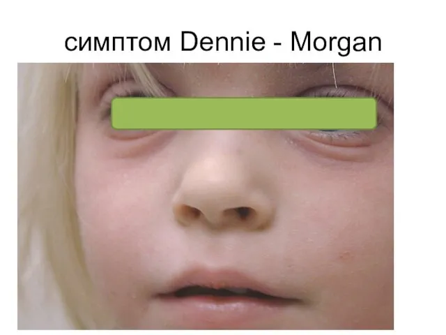 симптом Dennie - Morgan