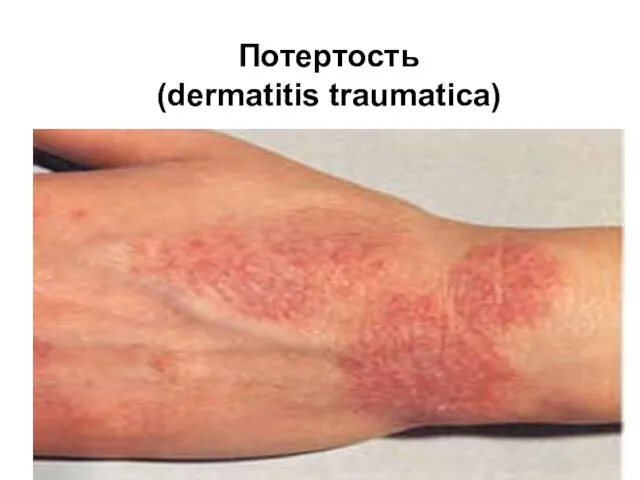 Потертость (dermatitis traumatica)