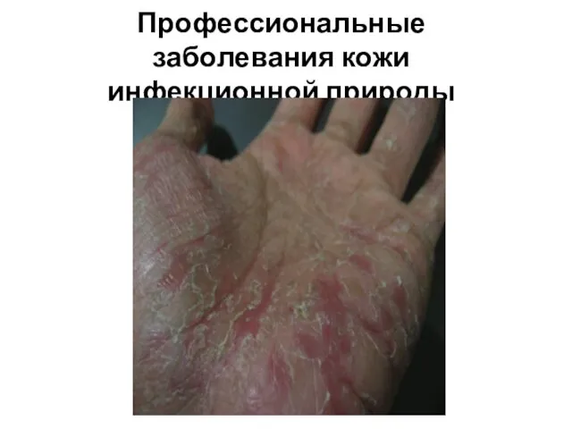 Профессиональные заболевания кожи инфекционной природы
