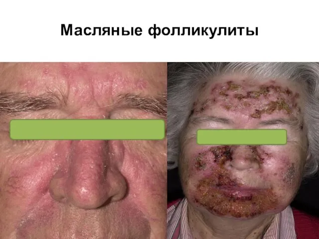 Масляные фолликулиты