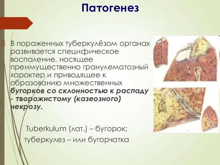 Патогенез В пораженных туберкулёзом органах развивается специфическое воспаление, носящее преимущественно гранулематозный характер и