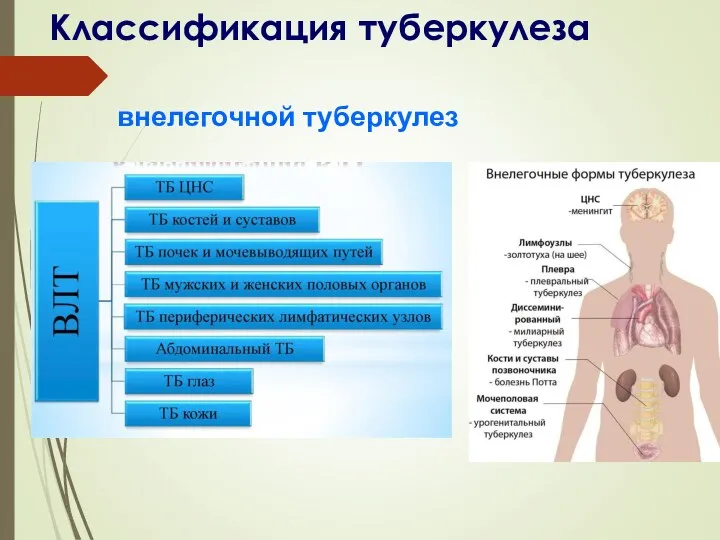 Классификация туберкулеза внелегочной туберкулез
