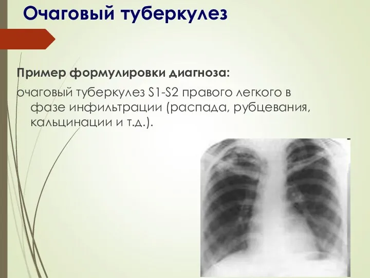Пример формулировки диагноза: очаговый туберкулез S1-S2 правого легкого в фазе инфильтрации (распада, рубцевания,