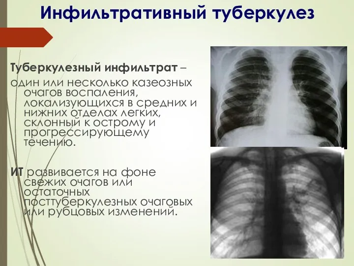 Инфильтративный туберкулез Туберкулезный инфильтрат – один или несколько казеозных очагов