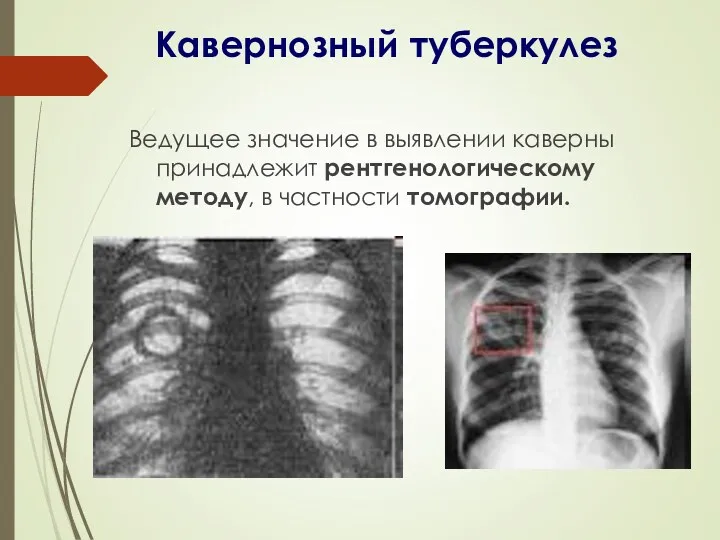Кавернозный туберкулез Ведущее значение в выявлении каверны принадлежит рентгенологическому методу, в частности томографии.
