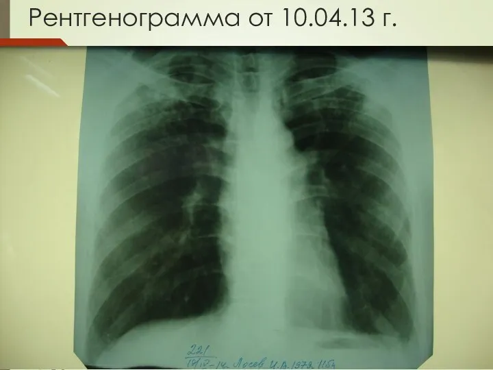 Рентгенограмма от 10.04.13 г.