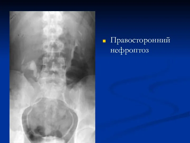 Правосторонний нефроптоз