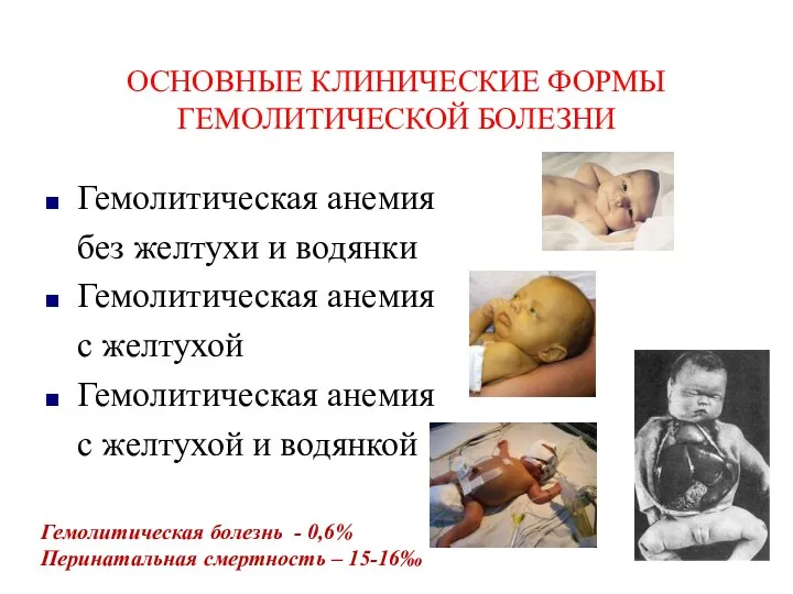 ОСНОВНЫЕ КЛИНИЧЕСКИЕ ФОРМЫ ГЕМОЛИТИЧЕСКОЙ БОЛЕЗНИ Гемолитическая анемия без желтухи и