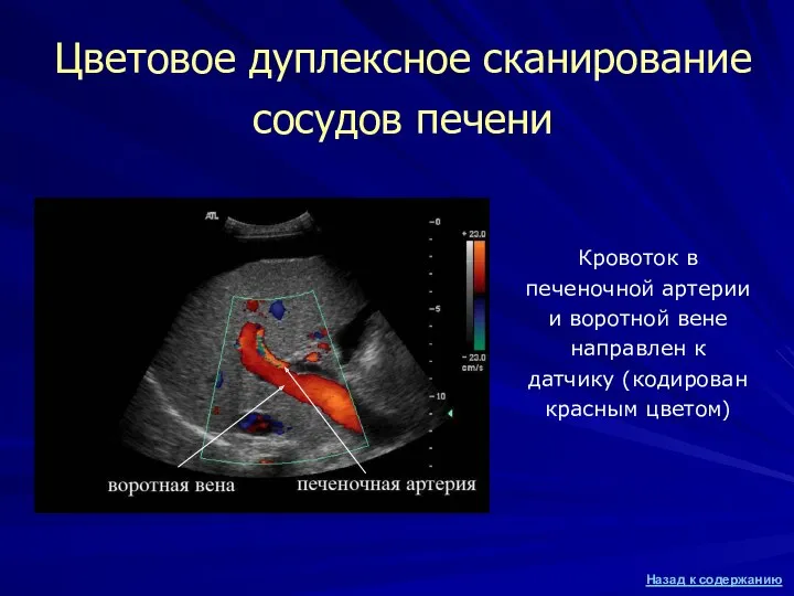 Цветовое дуплексное сканирование сосудов печени Кровоток в печеночной артерии и