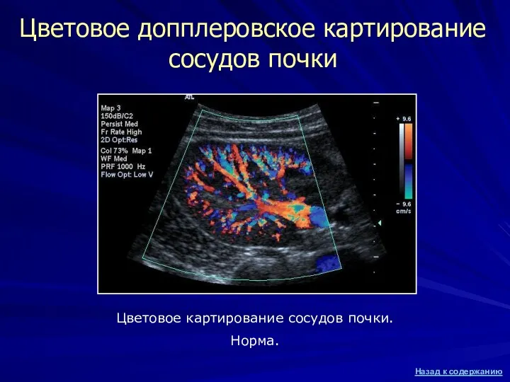 Цветовое допплеровское картирование сосудов почки Цветовое картирование сосудов почки. Норма.