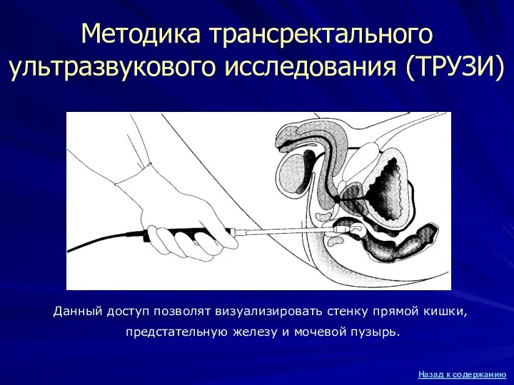 Методика трансректального ультразвукового исследования (ТРУЗИ) Данный доступ позволят визуализировать стенку