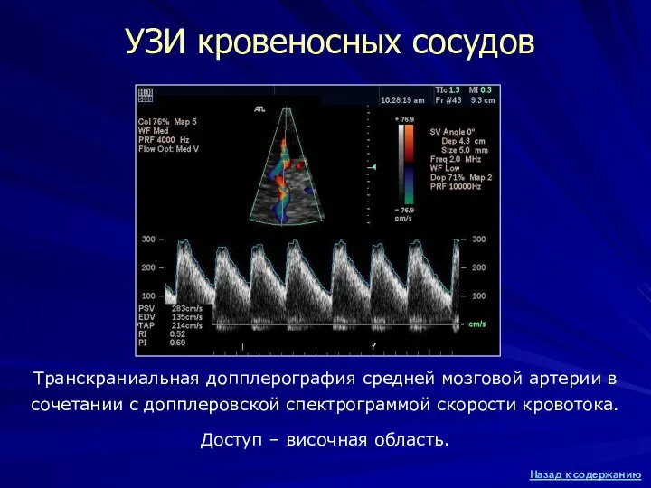 УЗИ кровеносных сосудов Транскраниальная допплерография средней мозговой артерии в сочетании