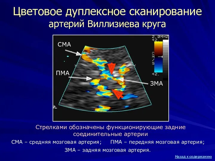 Цветовое дуплексное сканирование артерий Виллизиева круга Стрелками обозначены функционирующие задние