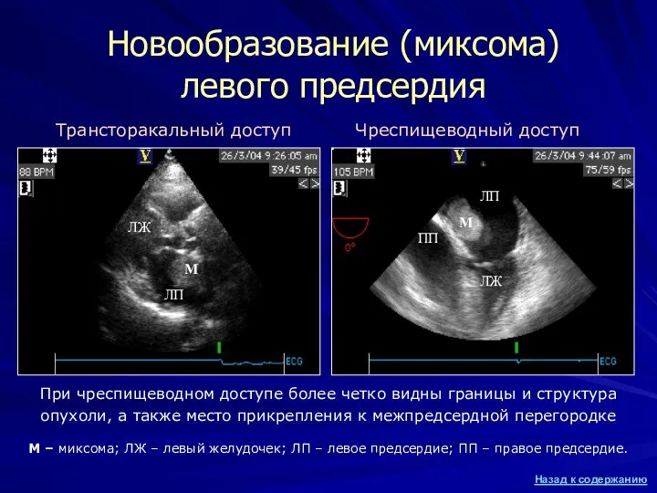 Новообразование (миксома) левого предсердия