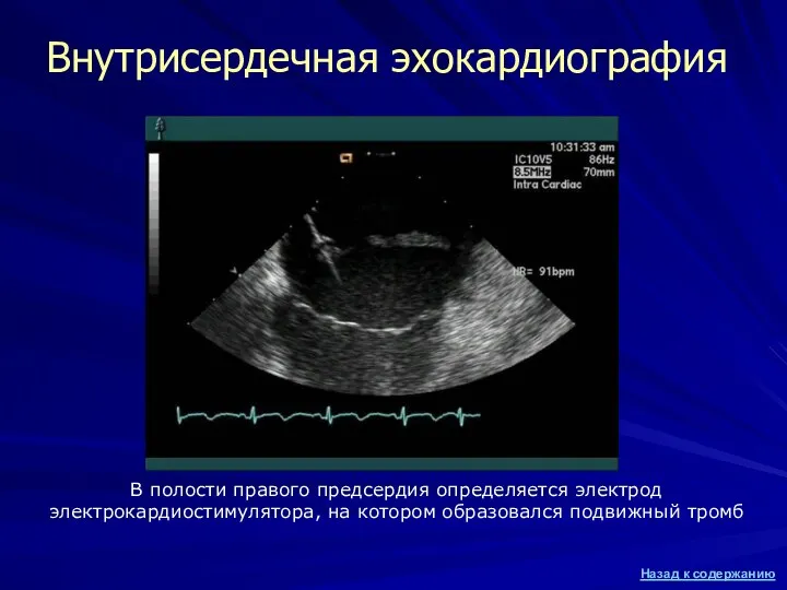Внутрисердечная эхокардиография В полости правого предсердия определяется электрод электрокардиостимулятора, на котором образовался подвижный тромб