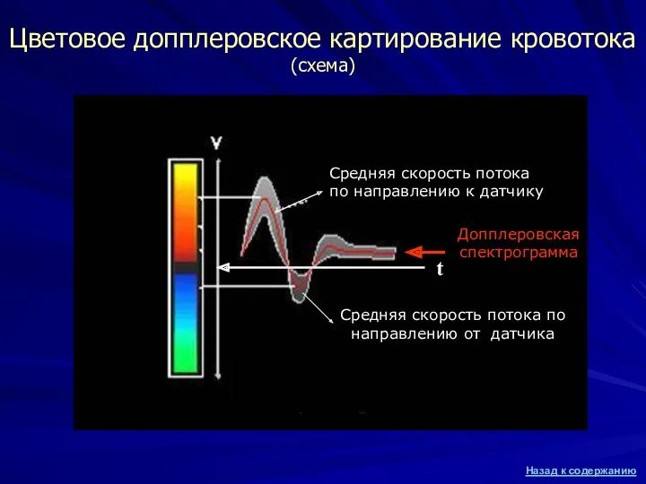 Цветовое допплеровское картирование кровотока (схема) Средняя скорость потока по направлению