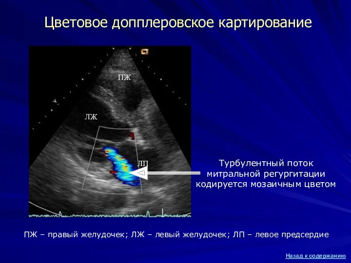 Цветовое допплеровское картирование Турбулентный поток митральной регургитации кодируется мозаичным цветом