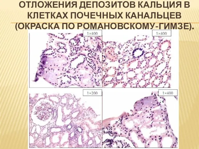 ОТЛОЖЕНИЯ ДЕПОЗИТОВ КАЛЬЦИЯ В КЛЕТКАХ ПОЧЕЧНЫХ КАНАЛЬЦЕВ (ОКРАСКА ПО РОМАНОВСКОМУ-ГИМЗЕ).