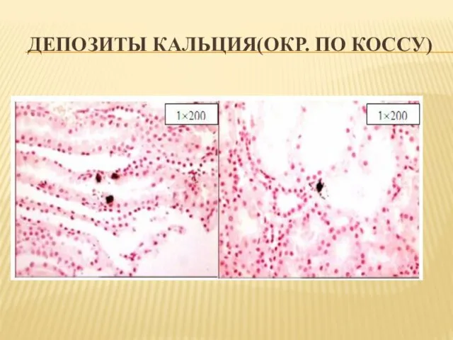 ДЕПОЗИТЫ КАЛЬЦИЯ(ОКР. ПО КОССУ)