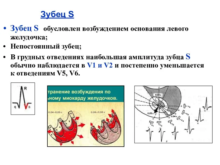 Зубец S Зубец S обусловлен возбуждением основания левого желудочка; Непостоянный