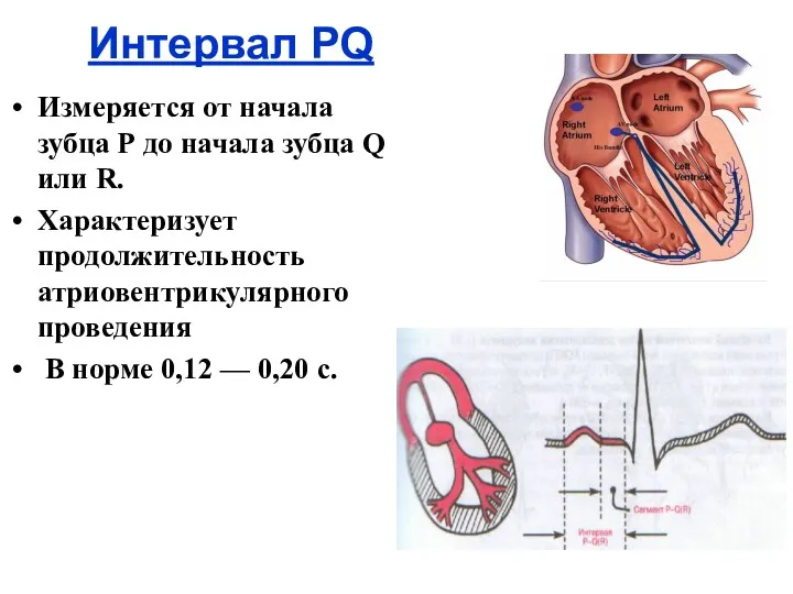 Интервал РQ Измеряется от начала зубца Р до начала зубца