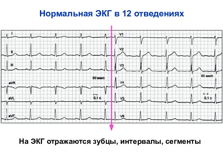 Нормальная ЭКГ в 12 отведениях На ЭКГ отражаются зубцы, интервалы, сегменты