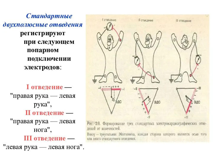 Стандартные двухполюсные отведения регистрируют при следующем попарном подключении электродов: I